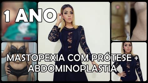 MASTOPEXIA COM PRÓTESE .